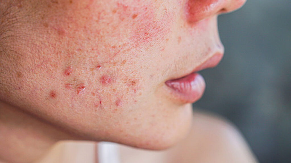 Tips-to-Getting-Rid-of-the-Issue-like-Hormonal-Acne-on-newstime